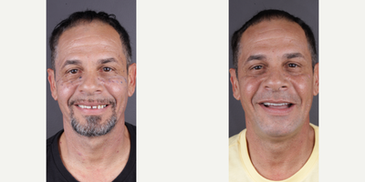 45-54 year old man treated with BriteSmile, ClearChoice Dental Implants, Dental Bone Graft, Dental Implants, Porcelain Veneers,  - Dental implants, All on 4