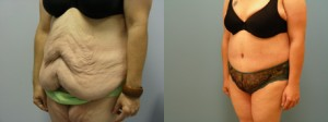 Woman treated with Liposuction - Woman treated with Liposuction