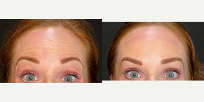 25-34 year old woman treated with Botox, Dysport, Jeuveau - 7 days post neurotoxin.