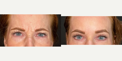 25-34 year old woman treated with Botox, Dysport, Jeuveau - 7 days post neurotoxin.