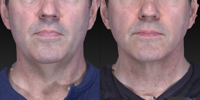 45-54 year old man treated with PrecisionTx, Smart Lipo, Skin Tightening - I have seen a significant increase in men seeking out procedures for aesthetic enhancements and rejuvenation.  Much of this stems from the Zoom effect.  Seeing oneself up close often views that we are not accustomed to seeing of ourselves.  Our patient was so happy with his results today that he wanted us to share his results using Vectra 3D photography.   He is only 2 months after a Laser Lift.  He will continue to see additional toning along his neck and jaw line.  He had lost significant weight and noticed saggy skin under his neck and jaw line.  Although a deep plane facelift would be the ideal procedure, he preferred the less invasive route.  Downtime was only a few days, and his results can last 3 to 5 years.