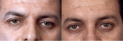 Blepharoplasty along with upper and lower eyelid lift. - 	Patient had droopy eyelids and eyebraws with excess skin of the upper and lower eyelids. He was very pleased with the natural and un-operated appearance after surgery.