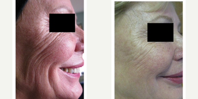 65-74 year old woman treated with Profhilo - This is after 2 sessions of Profhilo. She went on to have a third session that improved her results yet again!
