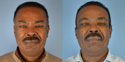 55-64 year old man treated with ArteFill - 63 year old male received ArteFill to cheeks, temples, and under eyes