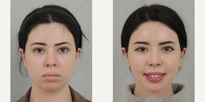 25-34 year old woman treated with V Line Surgery - V line + Fat graft in ID hospital