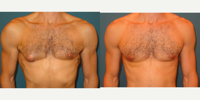 25-34 year old man treated with Male Breast Reduction- Correction of Gynecomastia - Patient is a young athletic male with right sided gynecomastia. He is unable to wear tighter fitting shirts and spend time at the beach or pool. He underwent resection of gynecomastia tissue through a small nipple incision and liposuction of the surrounding fatty tissue. Results are 1 week after surgery. No drain was used.