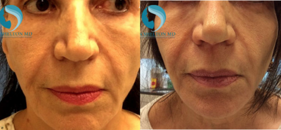 65-74 year old woman treated with Thread Lift - Silhouette InstaLift Suture lift.