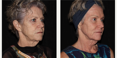 55-64 year old woman treated with SmartSkin, LED Light Therapy - This client has had SmartSkin CO2 laser of the face and neck. She has an excellent response even at day 10 as shown here. Her results will continue to improve over the course of 3 months. We also used TriWave LED light therapy sessions, twice per week, to speed her healing.