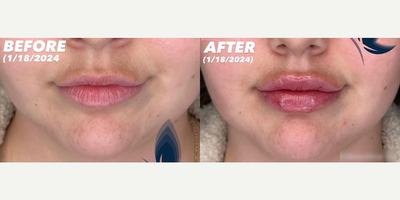 Woman treated with Lip Fillers, Restylane Kysse - Woman treated with Lip Fillers, Restylane Kysse