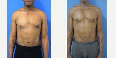 35-44 year old man treated with Pec Implants - 39 year old male from West Palm Beach, Florida 3 years after pectoral implants performed by Dr Sam Gershenbaum. He had previous gynecomastia surgery done elsewhere with too litle taken out of the right side and too much taken out of the left side with resultant deformity. dr Gershenbaum reduced the right side gynecomastia, transferred fat to the left side lower chest and placed custom pectoral implants under the muscle. He has dramatic, yet natural looking results and he could not be happier.
