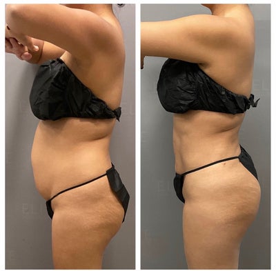 Awesome AirSculpt results & little downtime! 3 weeks post-op 