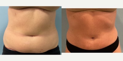 25-34 year old woman treated with Liposuction, Renuvion - This case involves a 30-year-old female who underwent liposuction targeting the abdomen and flanks with Renuvion. The procedure aimed to address localized fat deposits in these areas. The images displayed are taken from a front-facing perspective, showing the abdominal region before and 24 weeks after the procedure. Liposuction was completed 1.3 Liters in and 1 liter out. In the pre-operative photo, there is visible adiposity around the abdomen and flanks. The post-operative image reveals a reduction in these areas, with a more contoured abdominal profile. Notably, the skin appears smooth, and there are no significant post-surgical complications evident in the photograph. These results demonstrate the changes that can be achieved in body contour through targeted liposuction procedures. It is important to note that individual outcomes can vary based on several factors including patient's initial condition and adherence to post-procedure care guidelines.