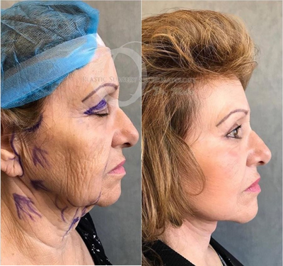 Woman treated with Neck Lift - Woman treated with Neck Lift.