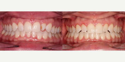 35-44 year old woman treated with Braces - This patient came in with her concern about her tooth being fully rotated and some slight crowding. She ultimately chose Clear Ceramic Braces as her treatment option to help rotate the tooth. In a total of 18 Months, she was able to become the smile masterpiece she has always wanted.