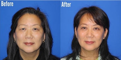 Woman treated with Brow Lift, Eyelid Surgery - Woman treated with Brow Lift, Eyelid Surgery