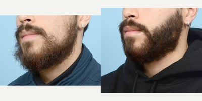 18-24 year old man treated with Hair Loss Treatment - Beard Transplant to fill in patches on cheeks.