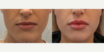 27 year old woman treated with Revanesse - Revanesse Versa Patient27 yo 1cc Revanesse Versa Tenting technique and into body of lip