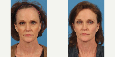 50 year old woman treated with TCA Peel - 50 year old woman treated with TCA Peel