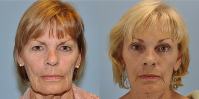 55-64 year old woman treated with Facial Fat Transfer - This 69 year old patient was treated with Autologous Fat Transfer to her face.