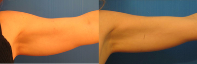 TriPollar - 
	Arms skin tightening after 5 treatments. Photos supplied by manufacturer, Pollogen Ltd, All Rights Reserved.
