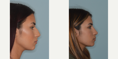 18-24 year old woman treated with Rhinoplasty - Female Hispanic patient who desired to decrease the projection of her tip and bridge from the profile while preserving very natural appearing results from the frontal view of the nose.
