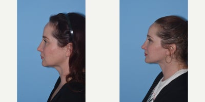 45-54 year old woman treated with Lower Facelift, Neck Lift - My lovely 44 year old patient did not like the looseness of her neck skin and muscle. The neck ages earlier than the face because the skin is much thinner and lacks good elasticity. Some patients necks age earlier than others based on many factors, such as environmental exposure and genetics. My patient wanted to nip this problem in the bud before her neck relaxed even more. She has a gorgeous neck and jawline result after a deep plane facelift and neck lift, platysmaplasty and is extremely happy. This result should last at least 10 years.