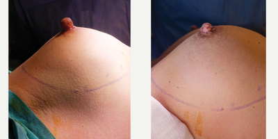 25-34 year old woman treated with Nipple Surgery - Nipple Reduction performed by Ozge Ergun, MD