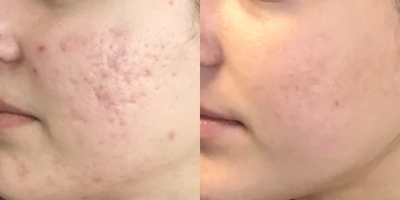 Woman treated with SkinPen - Woman treated with SkinPen Microneedling for treatment of acne scars