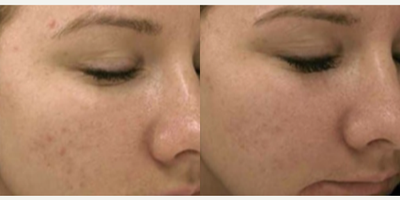 Woman treated with SkinPen - Woman treated with SkinPen Microneedling for treatment of acne scars