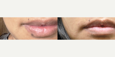 Laser lip Spot Removal with Q-switched lasers - Patient here for one dark spot at the lower lip.  Patient has type IV Asian skin and wanted to get rid of the brown spot at the right lower lip.  One treatment with our Palomar Q-Yag V laser did the trick!