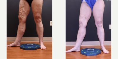 35-44 year old woman treated with EVLT, Sclerotherapy - Patient had EVLT performed and ultrasound guided sclerotherapy treatments for varicose veins.