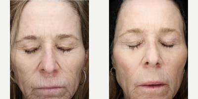 Woman treated with Scar Removal, Laser Scar Removal - Woman treated with Laser Resurfacing