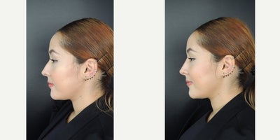 25-34 year old man treated with Nonsurgical Nose Job, Dermal Fillers, Juvederm, Restylane Lyft, RHA Collection Fillers - Non surgical nose job