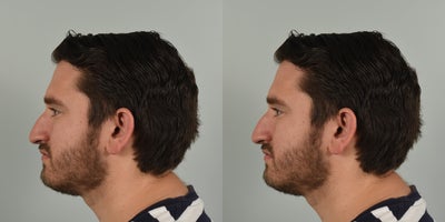 25-34 year old man treated with Rhinoplasty - 25 year old male wanting to smooth out dorsal hump and lift his drooping nasal tip.