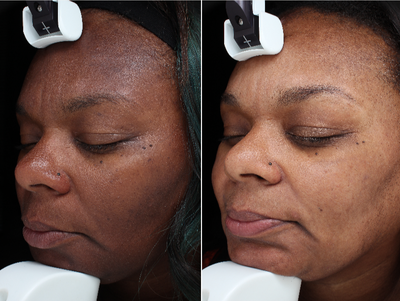 45-54 year old woman treated with Halo Laser - After 1 Halo Treatment