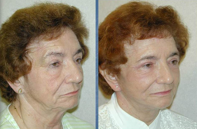 Eyelid Surgery - Eyelid Surgery