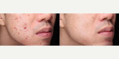 Man treated with Vampire Facial, Chemical Peel - Man treated with Vampire Facial, Chemical Peel