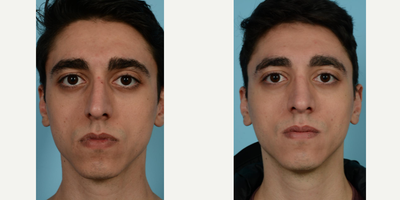 25-34 year old man treated with Rhinoplasty - At the age of 25, this patient chose to seek relief from a lifelong battle with nasal obstruction and breathing problems. His left nostril was notably more obstructed, impacting his ability to sleep and causing perpetual discomfort regarding a sensation of insufficient air intake. Further driven by a desire for an aesthetically pleasing nasal presentation, the patient ventured into a transformative journey that involved Rhinoplasty by Dr. Mustoe in Chicago. He sought a straight nose and a somewhat set back tip, complementing his overall facial features while alleviating his obstructed breathing.Utilizing his extensive expertise, Dr. Thomas Mustoe executed a meticulous septorhinoplasty and rhinoplasty using IV sedation anesthesia. Before performing this, he identified the patient's significantly deviated septum, complete with a septal spur and considerable deviation lower down, obstructing the left side of the patient's nose. A close look at this patient's before and after photos reveals an admirable outcome, showing a more desirable nose appearance accompanied by a resolution of his breathing issues.Undoubtedly, Rhinoplasty by Dr. Mustoe in Chicago proved to be a promising solution for this 25-year-old gentleman's longstanding nasal obstruction. Dr. Mustoe, who holds credentials from the American Board of Otolaryngology-Head and Neck Surgery and the American Board of Plastic Surgery, leveraged his rich familiarity with reconstructive methods to remarkably transform the patient's life. Practicing from TLKM Plastic Surgery located at 737 North Michigan Ave., #1500, Chicago, Dr. Mustoe has garnered extensive recognition for his significant contributions to the realm of plastic surgery. A glance at the 'before' and 'after' images illustrates the smooth journey of the patient, demonstrating the proficient application of Dr. Mustoe's expertise and his dedication to each patient's unique needs and preferences.