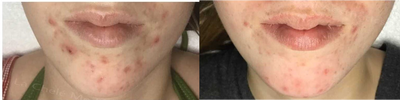 17 or under year old woman treated with Aerolase Neo - Patient treated with Aerolase Neo