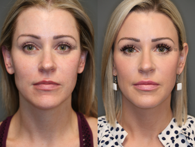 Filler and Laser - Filler rebalancing with laser resurfacing.