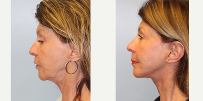 55-64 year old woman treated with Facelift - Facelift, 1 year postop.