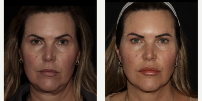 Woman treated with Emface - Emface
