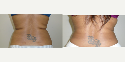 35-44 year old woman treated with Smart Lipo - pre and post PAL