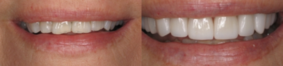 Invisalign/ Porcelain Veneers - First, Invisalign was used to help bring her teeth into the proper relation. Then she had two additional visits to help complete her ideal smile. SHe received 11 upper porcelain restorations. These restorations covered the gum recession. It also repaired the chipped and worn teeth to give Jane an attractive and even smile.