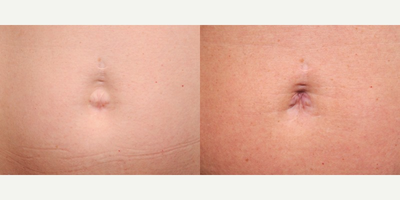 Belly Button Surgery - This patient complained that her belly button was too wide and too shallow.  I was able to help her improve both of these dimensions with a cosmetic umbilicoplasty (belly button surgery).  It was a fun little case that I performed in my office under local anesthesia.&nbsp;