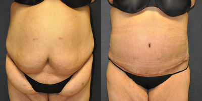34 year old woman treated with Body Lift - 34 year old woman who lost over 80 lbs requested rejuvenation of her abdomen. 4 weeks after Panniculectomy with Pubic Lift, Liposuction of Abdomen & Flanks by Dr. Steely.