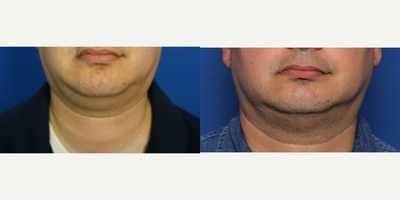 35-44 year old man treated with CoolMini - CoolMini CoolSculpting for a double chin