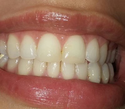 I have had caps on my front two teeth for 3 years and I want to get