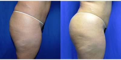 45-54 year old woman treated with Brazilian Butt Lift - 45 year old female 6 weeks after a Brazilian Butt Lift. Her height is 5 feet 4 inches and weight 179lbs. She has two children. She had vaser liposuction to her abdomen and back with 4300cc's of aspirate removed. She had 600cc's of fat placed in each buttock.