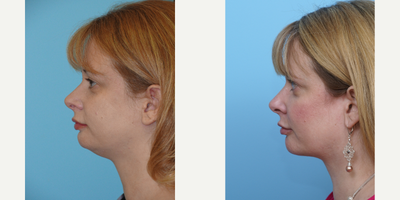 45-54 year old woman treated with Liposuction - This patient complained about the excess heaviness under her chin. She did not need a facelift as nothing had fallen down due to gravity. She simply had excess fat under her chin and throughout her neck. She had an in office liposuction with tumescent anesthesia to remove the excess fat.